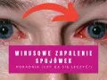 Czerwone, podrażnione oczy z czerwoną strzałką wskazującą na zapalenie. Poradnik: wirusowe zapalenie spojówek - jaki lek na zapalenie spojówek?
