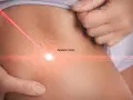 Czerwony promień lasera skierowany na rozstępy na biodrach, symbolizujący zabieg estetyczny.