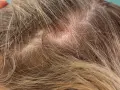 Nahaufnahme der Kopfhaut mit Haaren, die einen roten, schuppigen schorf am hinterkopf zeigen.