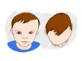 Ilustracja pokazuje niemowlaka z asymetrią główki, co może wskazywać na plagiocefalię.