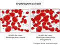 Vergleich von roten Blutkörperchen: Links normal, rechts erhöht (erythrozyten zu hoch). Polyglobulie durch Sauerstoffmangel.