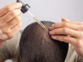 Mężczyzna aplikuje serum na skórę głowy, walcząc z przetłuszczającą się skórą głowy i problemami z włosami.