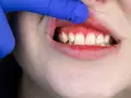 Wylecz zapalenie dziąseł: Od domowych metod po gabinet stomatologa