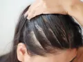 Nahaufnahme der Kopfhaut einer Person, die sich kratzt. Möglicherweise ein Anzeichen von Neurodermitis Kopfhaut.