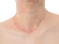 Piel con erupción rojiza y escamosa en el cuello, sugiriendo la presencia de hongos en el cuello.