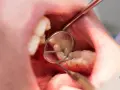 Zbliżenie na usta z widocznym zębem z ubytkiem, oglądanym przez lusterko dentystyczne.