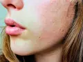 Primo piano del viso di una giovane donna con lentiggini e pelle che si squama, evidenziando una texture ruvida e secca.