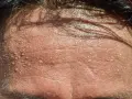 Frente sudorosa con gotas de agua. ¿Buscas trucos para no sudar por la cabeza?