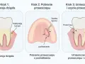 Ilustracja przedstawia trzy etapy zabiegu: recesję dziąsła, pobranie przeszczepu z podniebienia i umieszczenie go z szyciem.