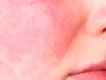Primo piano di pelle con rosacea, arrossamento diffuso e piccoli vasi sanguigni visibili sulle guance e sul naso.