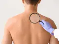 Dermatolog bada plecy pacjenta z licznymi białymi plamami na skórze, używając lupy.
