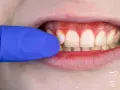 Widoczne są białe zęby i zaczerwienione, krwawiące dziąsła. Niebieska rękawiczka dentystyczna delikatnie odsłania problem.