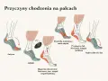 Ilustracja pokazuje przyczyny chodzenia na palcach, w tym autyzm, ADHD, dystrofię mięśniową, przykurcze ścięgna Achillesa i nadwrażliwość dotykową.