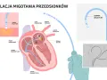 Ilustracja wyjaśnia, co to ablacja migotania przedsionków. Pokazuje cewniki diagnostyczne i ablacyjne w sercu, lokalizujące źródło arytmii.