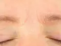 Skóra nad oczami jest zaczerwieniona i łuszczy się, co może być jednym z retinol skutki uboczne.