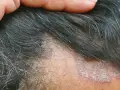 Juckende Kopfhaut mit schuppigen Stellen und Haarausfall. Eine Hand berührt die betroffenen Stellen.