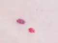 Dwa małe, czerwone znamiona na skórze. Jedno z nich ma wyraźne zaczerwienienie wokół pieprzyka, przypominające mały, purpurowy kwiat.