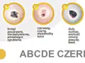 ABCDE czerniaka: asymetria, brzegi, czerwony/czarny kolor, duży rozmiar, ewolucja. Obrazki pokazują, jak wygląda czerniak.