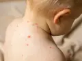 Skóra dziecka pokryta czerwonymi kropkami, objawami choroby, takiej jak odra.