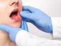 Drętwienie po dentyście: Jak długo potrwa? Wszystko, co musisz wiedzieć