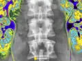 Kolorowa scyntygrafia kości pokazuje nerki i kręgosłup. Obraz uwidacznia obszary o różnej aktywności metabolicznej.