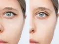 Przed i po zabiegu direct brow lift. Widoczne uniesienie brwi, odmłodzenie spojrzenia.