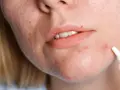 Kobieta aplikuje krem na wyprysk, szukając skutecznych zabiegów na trądzik hormonalny.
