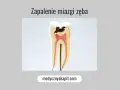 Model zęba ukazujący próchnicę i zapalenie miazgi.