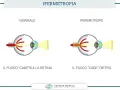 Confronto tra occhio normale e occhio ipermetrope. Nell'ipermetropia lieve, il fuoco cade dietro la retina, rendendo sfocati gli oggetti vicini.
