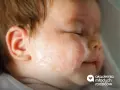 Skóra niemowlaka z zaczerwienieniem i suchymi plamkami, objawy alergii u dzieci.