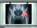 RTG miednicy z zaznaczonym bólem biodra. Czy rwa kulszowa wyjdzie na RTG? Zwykle nie, ale zmiany zwyrodnieniowe mogą ją powodować.