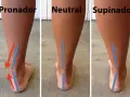 Comparación de pisada: pronador, neutral y supinador. La pisada supinadora muestra el tobillo inclinado hacia afuera.