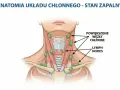 Anatomia układu chłonnego - stan zapalny. Widoczne powiększone węzły chłonne na szyi.