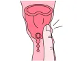 Dłoń naciska na kubeczek menstruacyjny. Tworzywo TPE, choć popularne, może budzić pytania o jego szkodliwość.