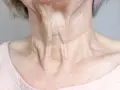 Primer plano del cuello flácido de una mujer mayor, mostrando arrugas y pliegues pronunciados.