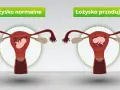 Porównanie: łożysko normalne vs łożysko przodujące. Po prawej stronie widoczna macica z płodem i łożyskiem przodującym, blokującym szyjkę macicy.