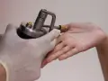 Application d'azote liquide sur une verrue pour un traitement par cryothérapie.