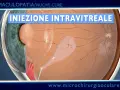 Iniezione intravitreale per trattare l'emorragia maculare. La macula, colpita da un'anomalia, riceve il farmaco.
