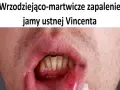 Wrzodziejące zapalenie jamy ustnej Vincenta. Widoczne owrzodzenie na wardze dolnej, wymagające leczenia.