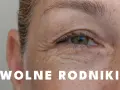 Zmarszczki wokół oka, piegi i tekst "Wolne rodniki" sugerują, że to one przyspieszają starzenie skóry.
