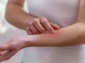 Dłoń drapiąca zaczerwienioną skórę na przedramieniu, objaw mogący wskazywać na lupus.