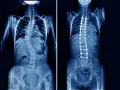 Rentgen klatki piersiowej pokazuje skoliozę kręgosłupa przed i po operacji korekcyjnej z implantami.