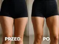 Porównanie: przed i po zabiegu. Wewnętrzna strona ud wygląda na gładszą i bardziej napiętą po.