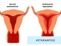 Porównanie prawidłowego endometrium z jego przerostem. Po lewej zdrowa macica, po prawej przerost endometrium.