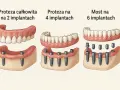 Nowe zęby koszt: proteza na 2, 4 lub 6 implantach. Ilustracja pokazuje różne opcje odbudowy uzębienia.