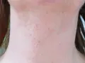 Delikatne wybroczyny u dziecka na szyi, widoczne drobne czerwone kropki na jasnej skórze.