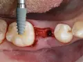 Kiedy implant po wyrwaniu zęba? Poznaj kluczowe terminy i ryzyka