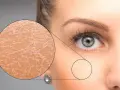 Gros plan sur une peau sèche et craquelée, expliquant pourquoi j'ai la peau sèche. Une loupe révèle la texture rugueuse.