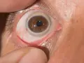 Occhio con iride marrone e un sottile anello di Weiss visibile intorno alla pupilla.