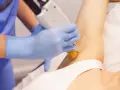 Depilacja laserowa: czy boli? Poznaj prawdę i metody łagodzenia bólu